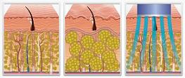Cellulite