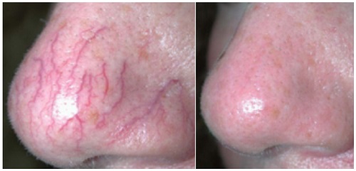 before after